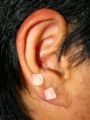 Auricular Therapy