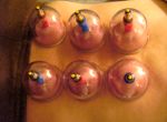 Cupping Therapy